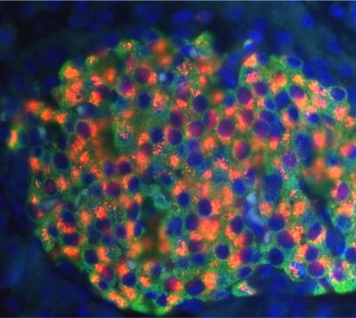 The insulin-secreting beta cells (green) normally exhibit a perinuclear cap of proinsulin (orange in top panel) whereas proinsulin is spread throughout the cytoplasm (orange in bottom panel) in many beta-cells of PERK-deficient mice, which are diabetic because of insufficient secretion of insulin.
