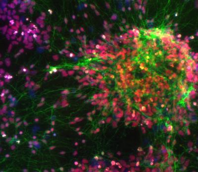 Scientists at Penn State University, the Salk Institute for Biological Studies, and other institutions have developed a method for recreating a schizophrenic patient's own neurons in the laboratory. In this microscopic image, nuclei originated from human cells are stained red and stem-cell-derived newborn neurons are stained green. Credit: Gong Chen Laboratory, Penn State University