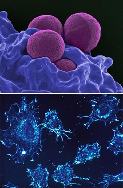 Methicillin-resistant Staphylococcus aureus (top, purple), cancer cells (bottom). Treatment designed to contain, rather than eliminate, chronic infections or tumors where drug resistance can emerge may delay treatment failure. Credit: NIAID (MRSA), Dr Cecil Fox (Photographer), via Wikimedia Commons (cancer cells).